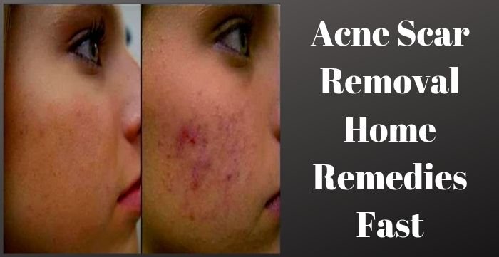Acne Scar Removal Home Remedies Fast