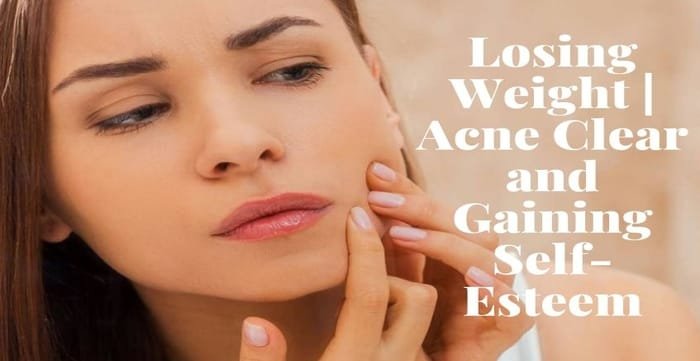 Losing Weight Acne Clear and Gaining Self-Esteem