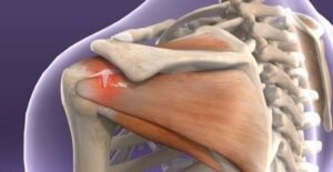 rotator cuff repair