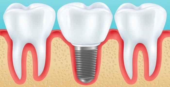 finding the right periodontist