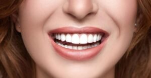 smile makeover