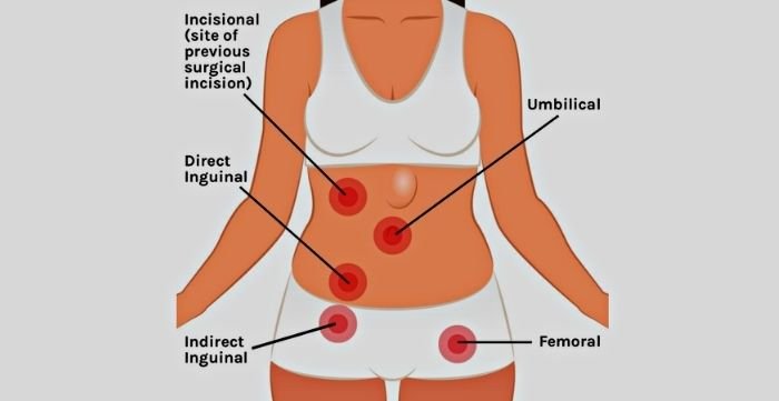 different types of hernias