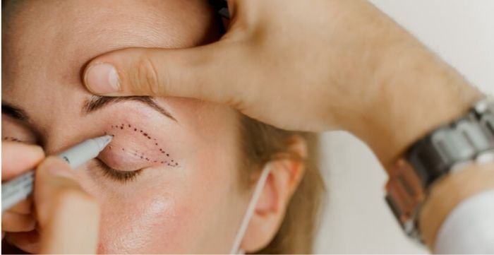 Ptosis surgery singapore ptosis surgery singapore