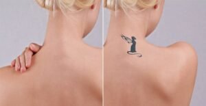 tattoo removal