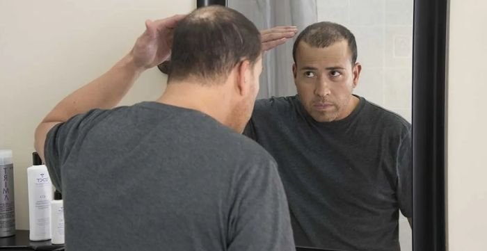 hair transplant myths debunked