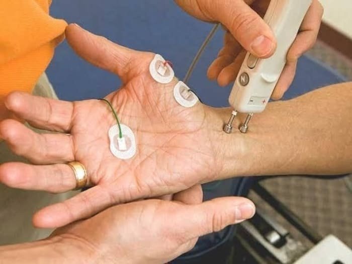 carpal tunnel syndrome