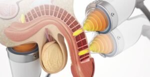 how shockwave therapy can treat erectile dysfunction