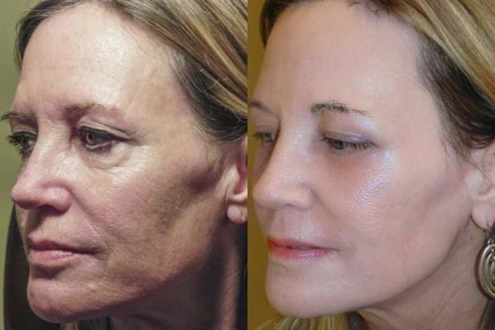 what can Fotona 4D do for your face