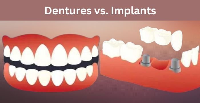 dentures vs implants
