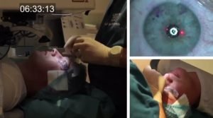 LASIK eye surgery