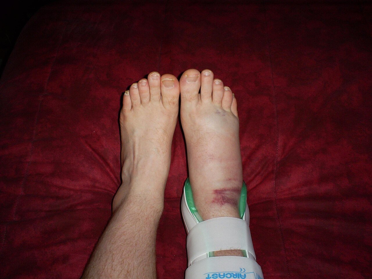 ankle sprain supported with an ankle brace